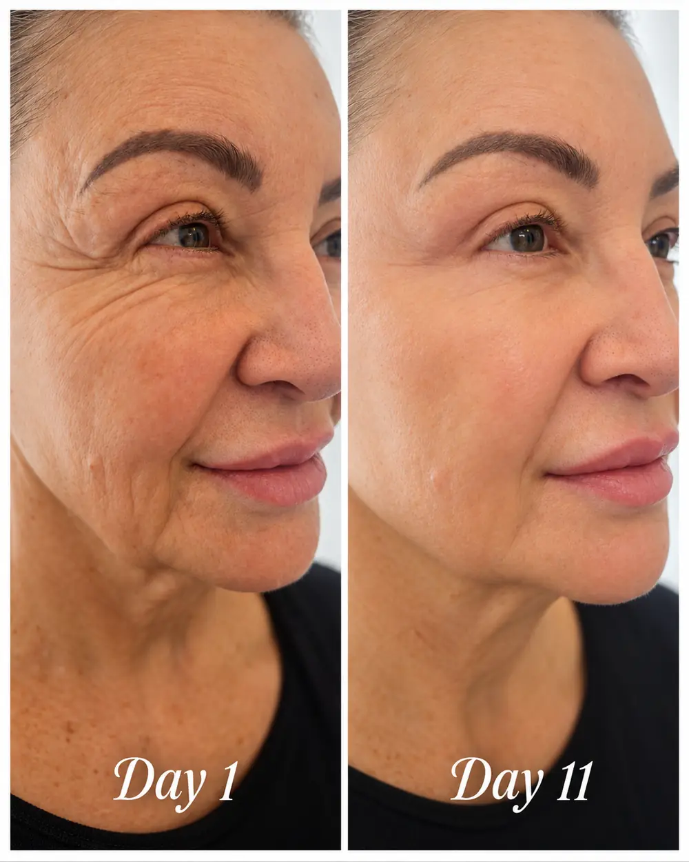 Two frames of the same client's face side by side, captioned day 1 and day 11 in the photograph.