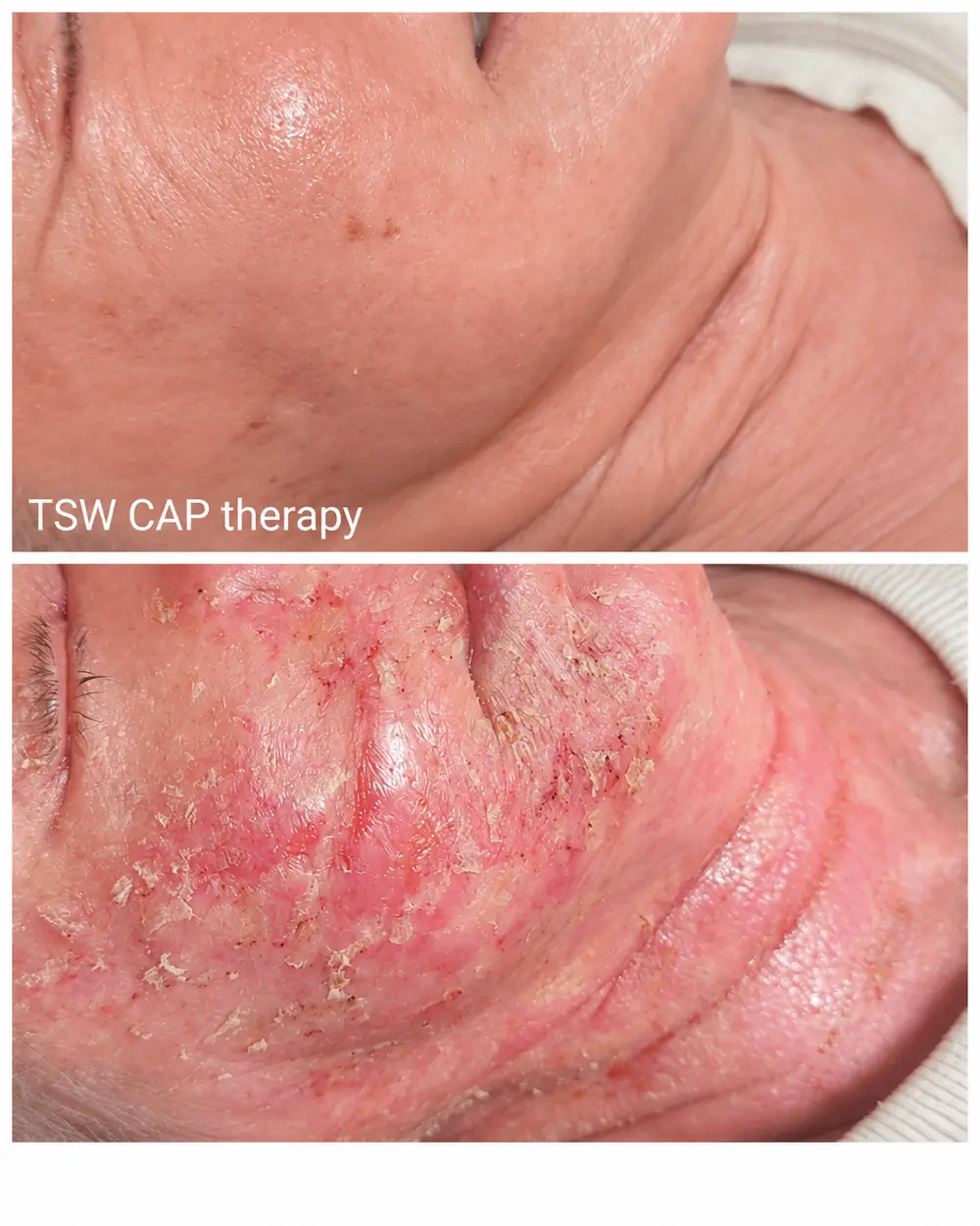 Two frames of the same client's neck and jaw, captioned TSW CAP therapy in the photograph.