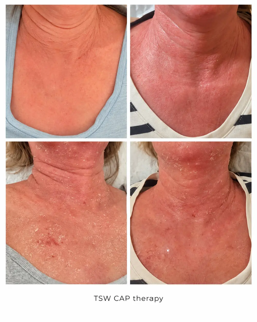 Four frames of the same client's neck and chest, captioned TSW CAP therapy in the photograph.